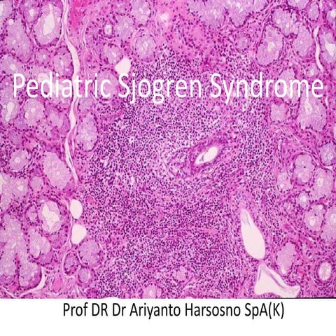 Pediatric Sjogren syndrome
