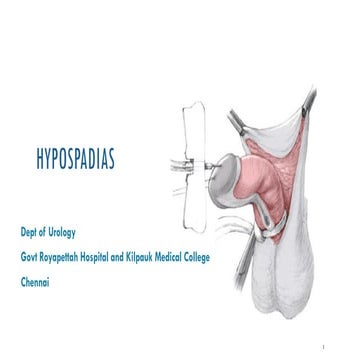 Hypospadias 3: MAGPI & snod grass (TIP) step by step operative urology ...
