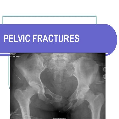 Pelvic fractures