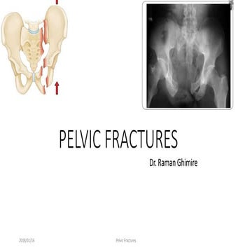 Pelvic fractures