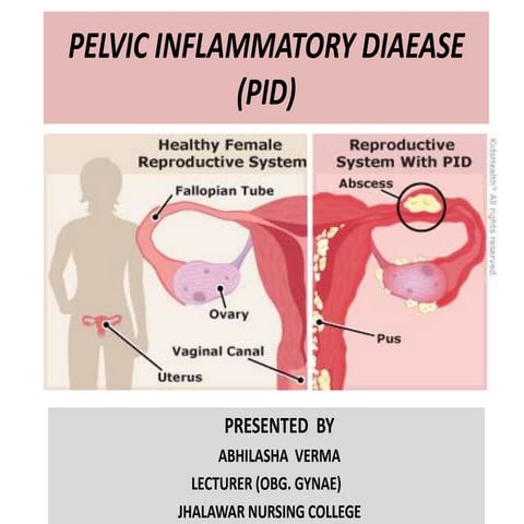 Pelvic inflammatory diaease