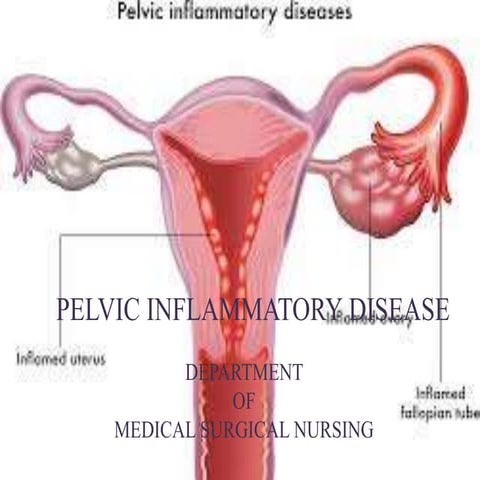 Pelvic inflammatory disease