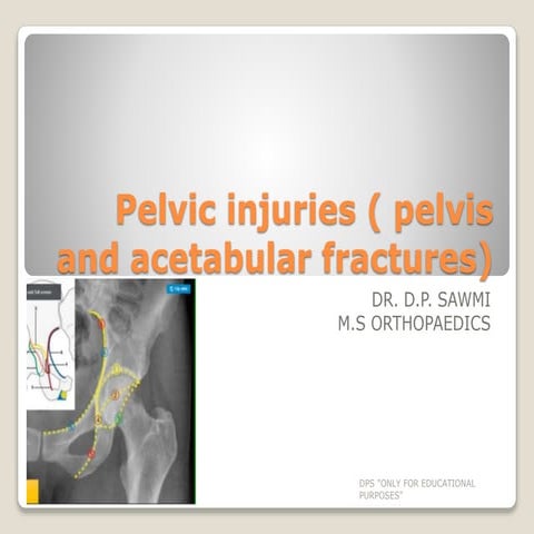 Kite String Injury Causing a Complete Tear of the Tendoachilles | PDF
