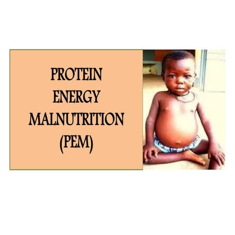 PROTEIN ENERGY MALNUTRITION | PPTX