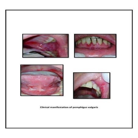 pemphigus vulgaris: autoimmune disease.pptx