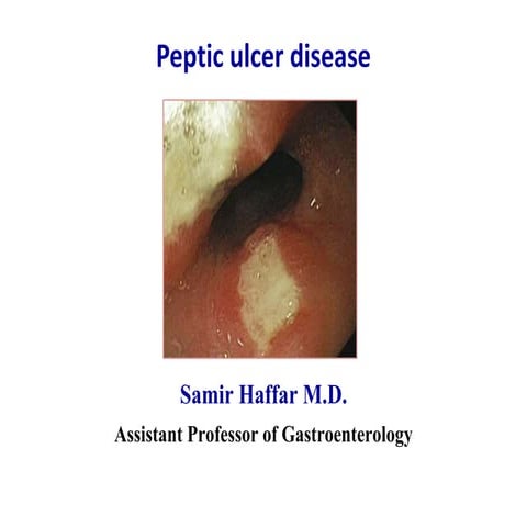 CASE PRESENTATION ON PEPTIC ULCER DISEASE(PUD) | PDF