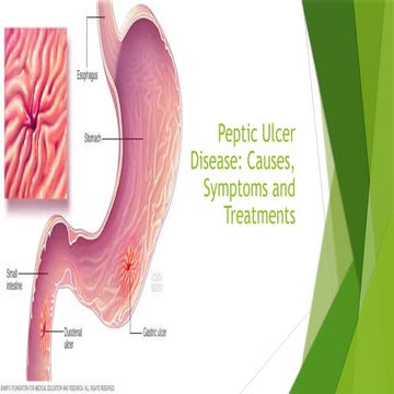 Pathology of Peptic Ulcer | PPTX