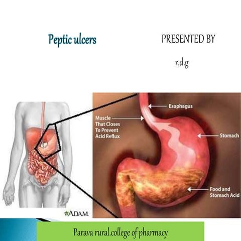 Peptic Ulcers Pathophysiology
