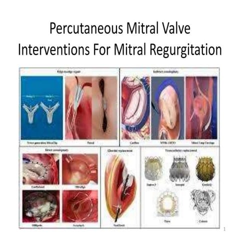Percutaneous mitral valve interventions for MR