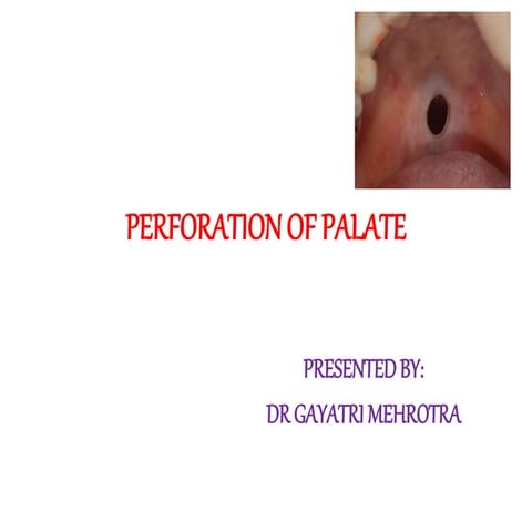 Perforation of palate | PPTX