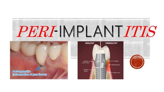 Periimplantitis | PPT