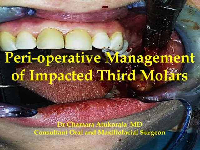 Impacted third molar management 