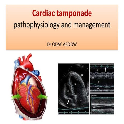 Pericardial tamponade