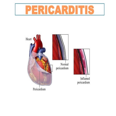 pericarditis-21ydudbbbjgijj0515080610.pptx