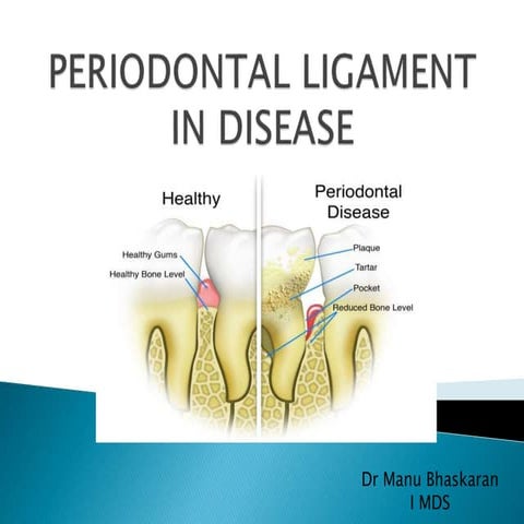Periodontal ligament in disease 