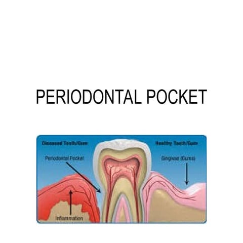 PERIODONTAL_POCKET- Pathogenesis and formation.ppt