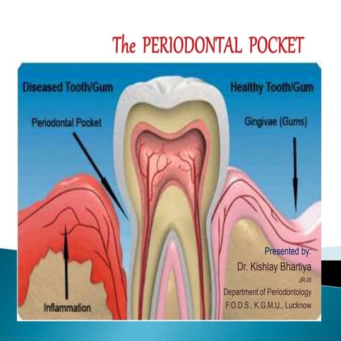 Periodontal Pocket