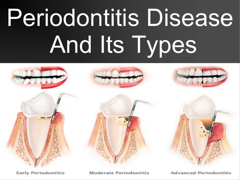 Periodontitis disease and its types