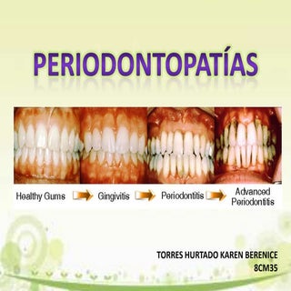 Periodontopatías