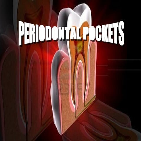 Periodontal pockets
