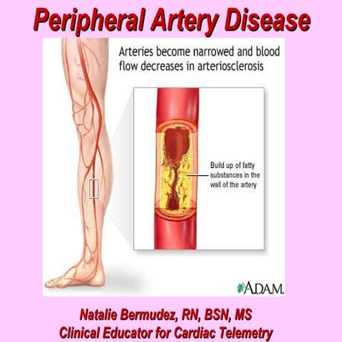 Peripheral Artery Disease - BMH/Tele