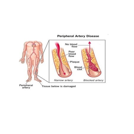 Peripheral Artery Disease - USA Vascular Centers | PDF