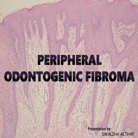 Peripheral odontogenic fibroma