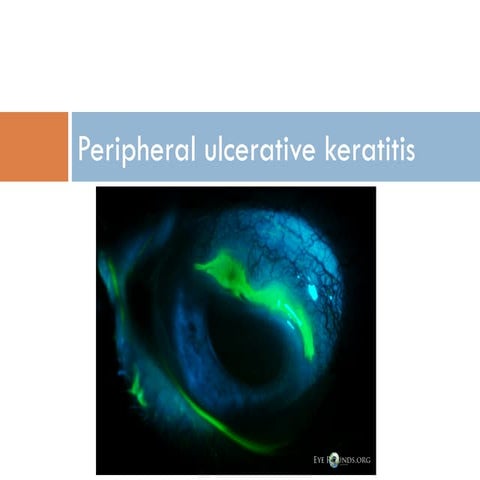 Peripheral Ulcerative Keratitis ( PUK )
