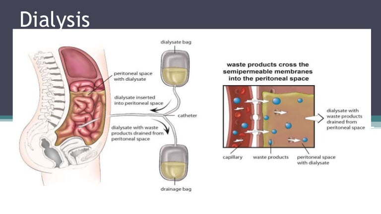 Peritoneal dialysis diagram of hemodialysis 