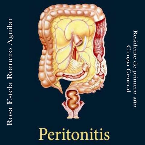 Peritonitis | PPTX