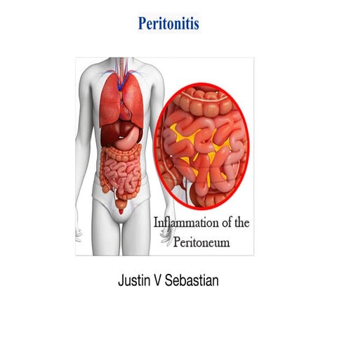 Peritonitis.pdf