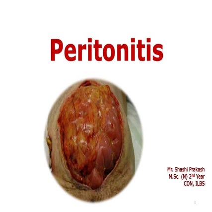 Peritonitis     Seminar             pptx