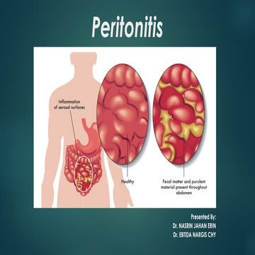 Peritonitis | PPTX