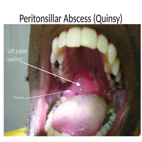 QUINSY (Peritonsillar Abscess) | PPT