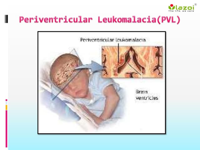 Cardiovascular disease | PPTX