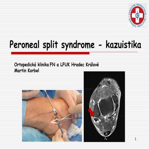 Peroneal split syndrome