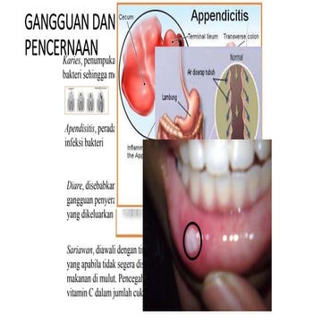 Pertemuan 16 Gangguan system pencernaan manusia.pptx