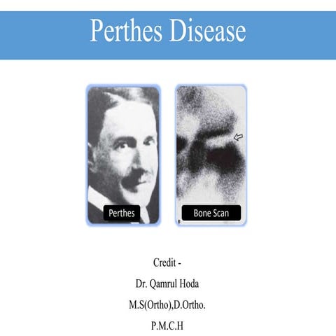Perthes disease