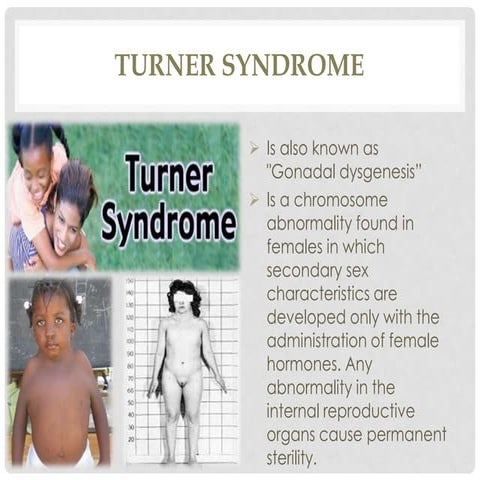 Pervasive developmental disorders (turner syndrome, klinefelter's syndrome)