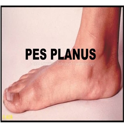Pes planus