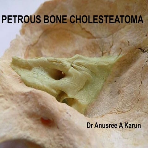 Petrous cholesteatoma sample