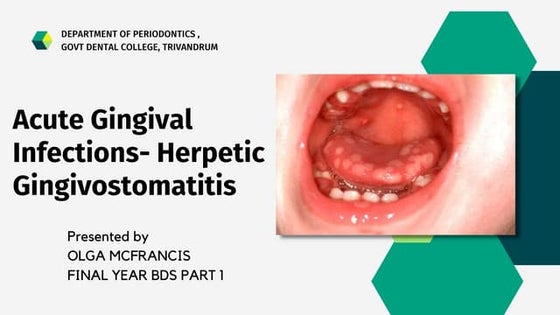 Gingivostomatitis In Children | Acyclovir for herpetic ...