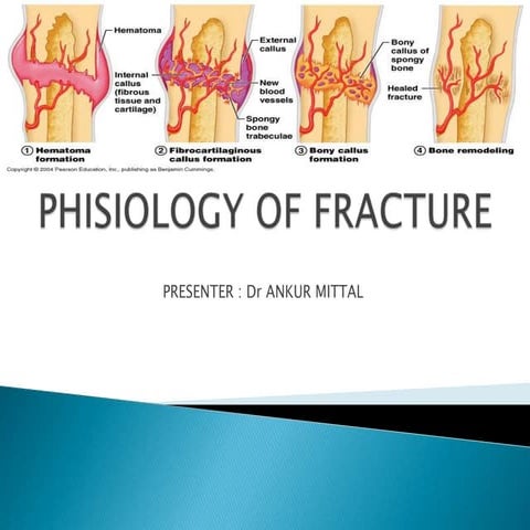 Phsiology of fractures