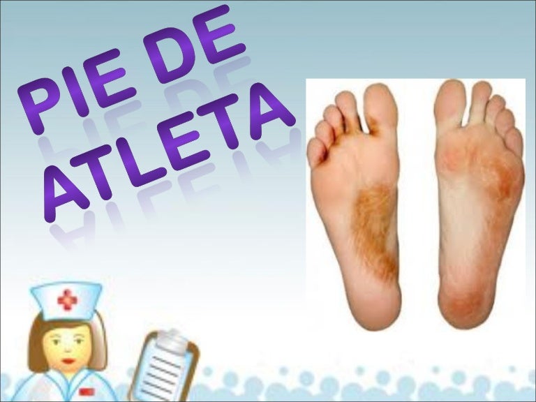 Pie de atleta