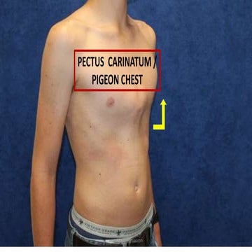 Pigeon chest / Pectus Carinatum 