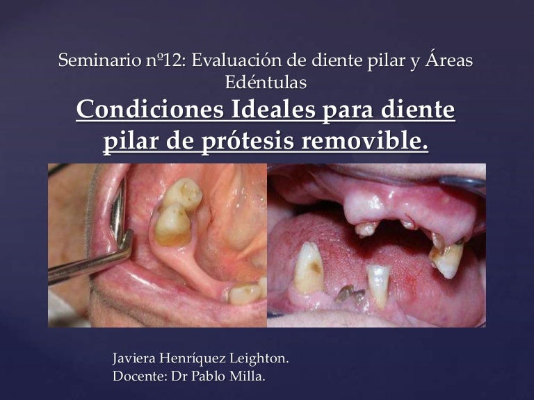Dientes Pilares En Protesis Parcial Removible