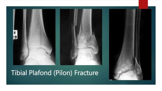 Humeral Shaft Fracture.pptx