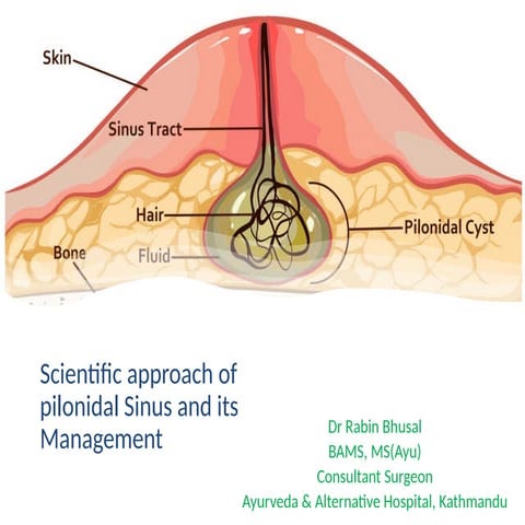 Vidradhi (Abscess) | PPTX