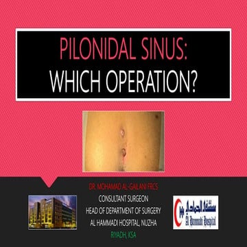 Pilonidal Sinus: Which Operation?