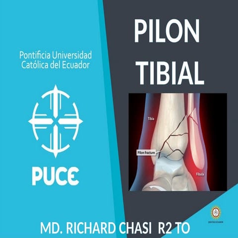 Pilon tibial | PPTX